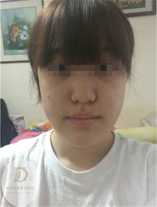 韩国女神下颌角整形术前照片