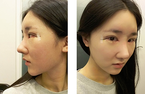 在韩国加美整形外科做了眼鼻整形