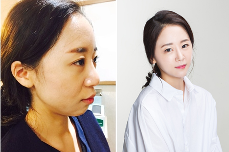 韩国GNG整形外科隆鼻展示