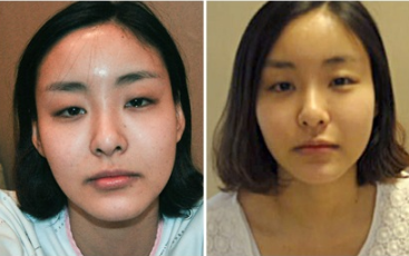 韩国灰姑娘和博朗温轮廓手术日记对比！