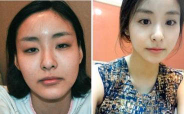 韩国灰姑娘医院轮廓手术对比