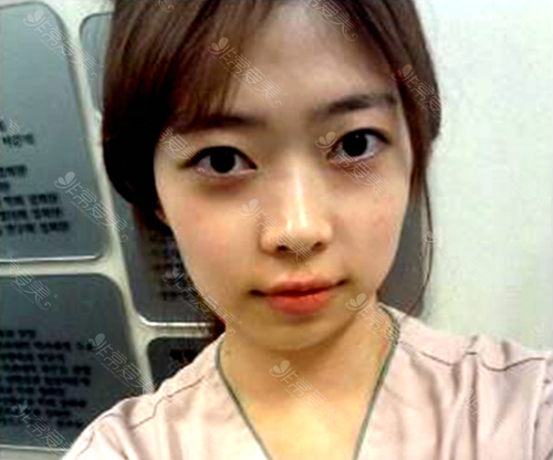 韩国巴诺巴奇整形医院朴钟林面部轮廓手术前照片