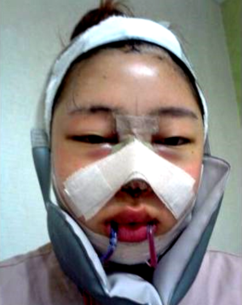 韩国巴诺巴奇整形医院朴钟林面部轮廓术后第1天照片