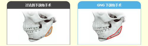 韩国GNG整形外科下颌角示意图