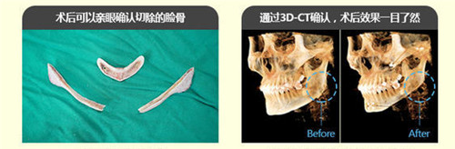 韩国GNG整形外科下颌角对比