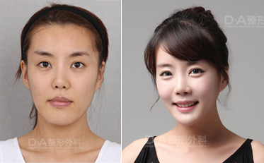 韩国DA整形外科轮廓整形案例对比