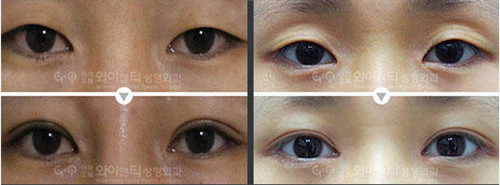韩国YNT双眼皮对比案例