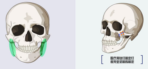 dr.朵整形外科颧骨整形特点分析