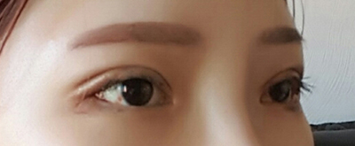 在韩国RUBY整形外科做双眼皮整形