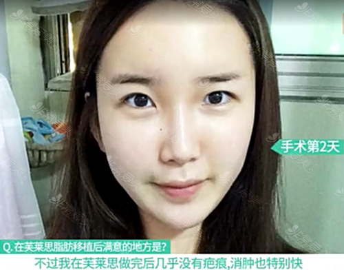 在韩国芙莱思整形医院做完全脸脂肪填充第2天