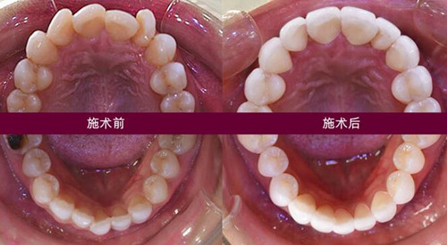 ID整形医院牙齿瓷贴面效果对比图