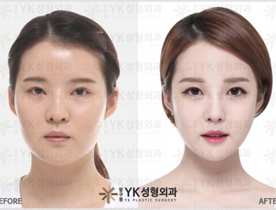 韩国YK整形医院童颜轮廓手术案例对比