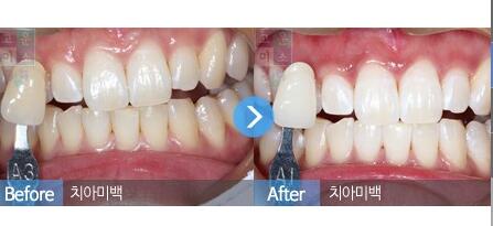 微笑牙科牙齿瓷贴面对比图