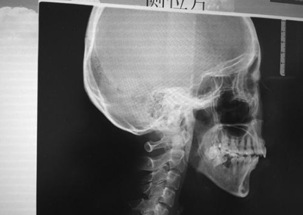 颧骨整形面部CT图