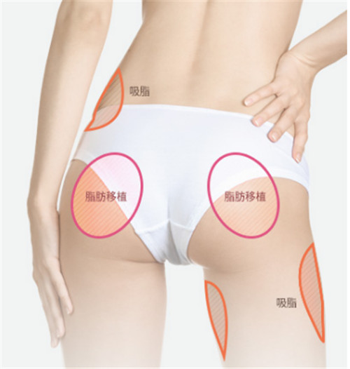 韩国ID臀部整形示意图