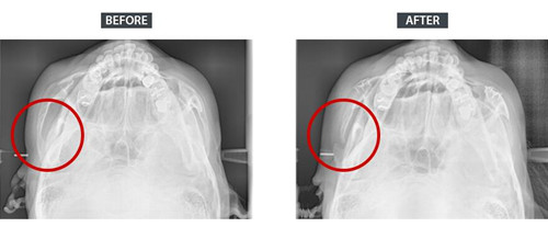 cooki整形医院颧骨颧弓整形CT对比图