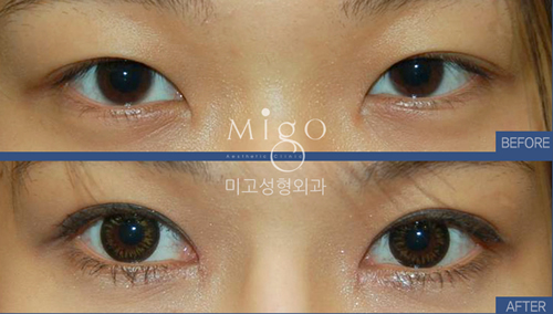 韩国MIGO医院双眼皮手术案例