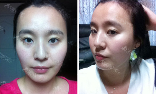 土妞变御姐，韩国拉菲安整形医院面部轮廓手术分享