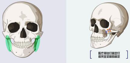 dr.朵整形医院颧骨颧弓缩小术固定方式