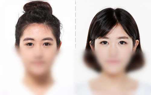 韩国ID医院双眼皮手术日记对比