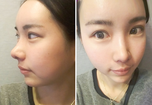 在韩国加美整形外科做了假体隆鼻手术