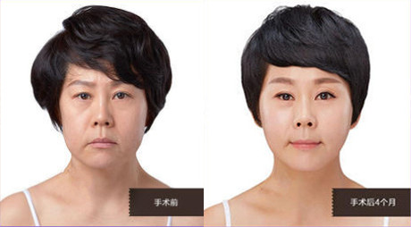 韩国原辰VS秀美颜面部埋线提升的特色对比