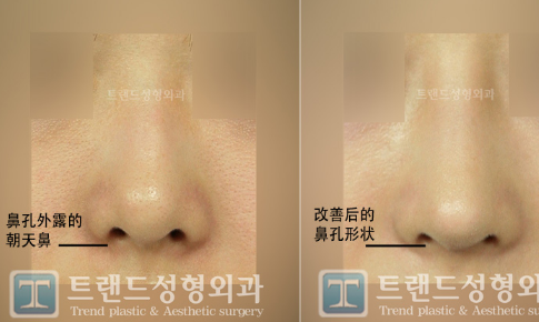 trend鼻孔外露修复对比图