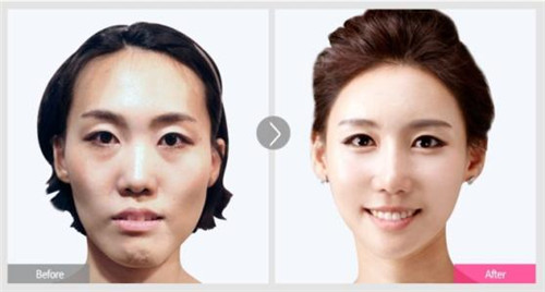韩国faceline整形外科颧骨整形案例