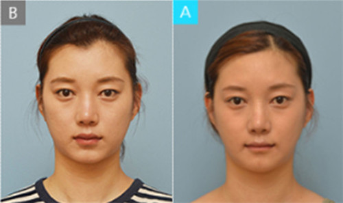 韩国布拉德整形外科颧骨整形案例