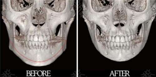 韩国明星去哪家医院做颧骨、下颌角轮廓整形？
