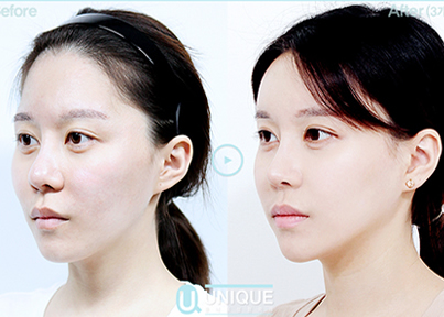 韩国优尼克整形外科隆鼻案例对比