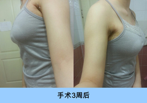 韩国ID隆胸日记：拥有柔软、高挺的美胸原来只需要三个月