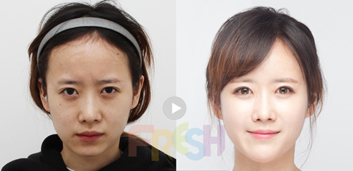 韩国芙莱思医院双眼皮修复案例展示