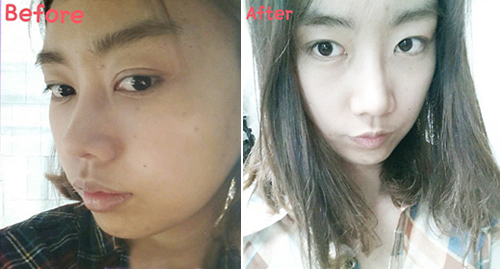 韩国艾源整形外科双眼皮修复案例