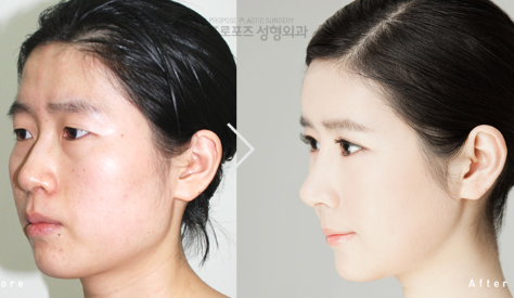 韩国PROPOSE鼻子+脂肪填充效果前后对比图