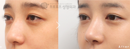 韩国PROPOSE鼻子+脂肪填充效果前后对比图