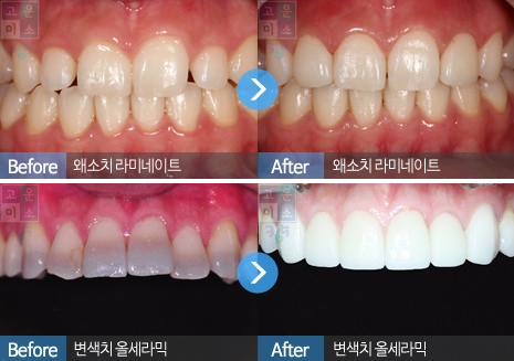韩国江南美丽微笑牙科牙齿矫正案例展示