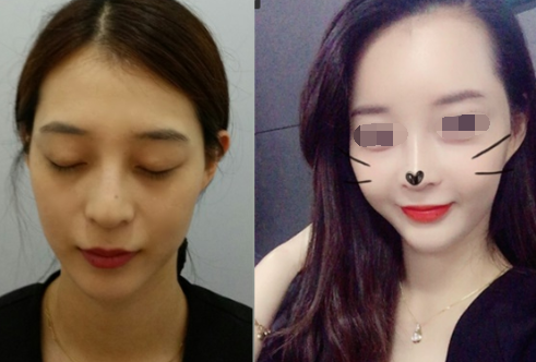 韩国宝士丽bocelle鼻综合前后对比图↑