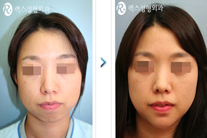 韩国REX整形外科轮廓整形案例对比