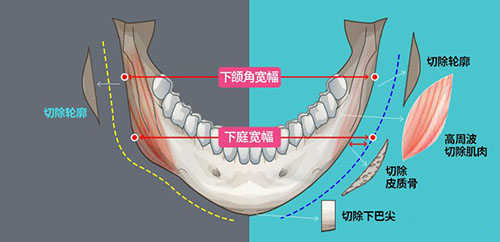 下颌角整形手术分析图