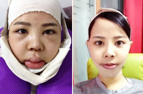 在韩国巴诺巴奇医院做了面部轮廓手术