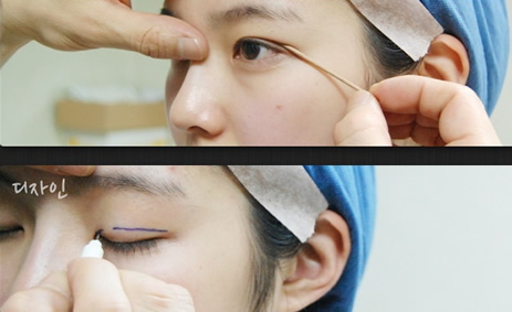 韩国清潭优医院做双眼皮手术特点展示