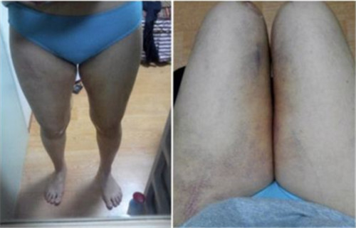 韩国巴诺巴奇大腿吸脂3个月恢复图