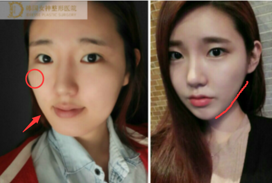 韩国女神面部轮廓术后日记怎么样，医院地址在哪？