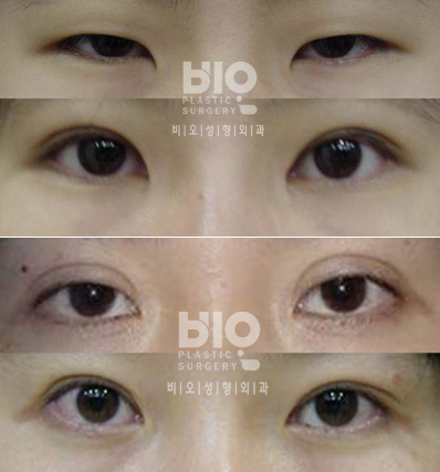 韩国半岛眼整形外科双眼皮日记对比