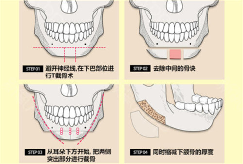 韩国NJH卢钟勋整形外科下颌角整形示意图