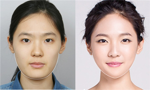 韩国NJH卢钟勋整形外科下颌角整形案例