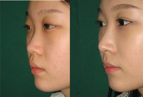 韩国可安美整形外科隆鼻案例