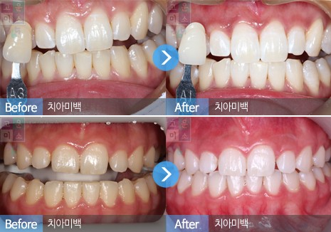 韩国江南美丽微笑牙科做牙齿美白效果明显吗？