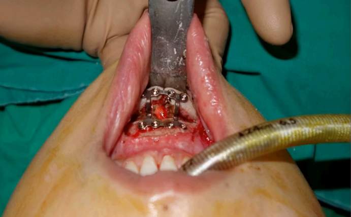 隆下巴手术切开口腔黏膜，剥离下巴后拍摄的照片